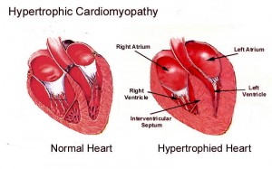 hypertrophic cardiomyopathy volleywood admin aug am comments